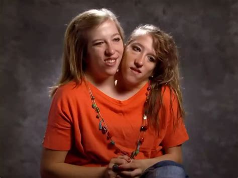 conjoined twins porn|real conjoined twins Search